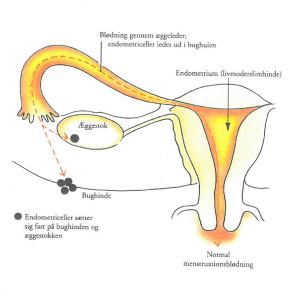 Endometrioseceller placeret p&aring; bughinden og &aelig;ggestokken, hvor de s&aelig;tter sig fast.