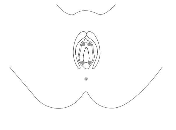 De 4 kirteludmundinger, som er placeret ved skedeindgangen og omkring urinr&oslash;ret, er markeret med gr&aring;.