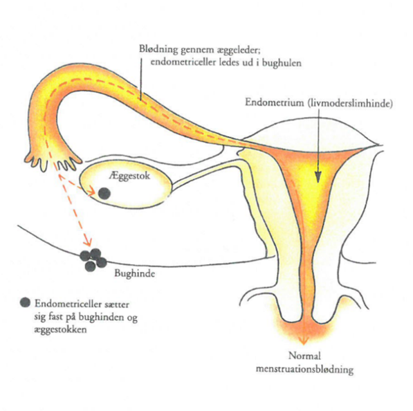 Endometrioseceller placeret på bughinden og æggestokken, hvor de sætter sig fast.