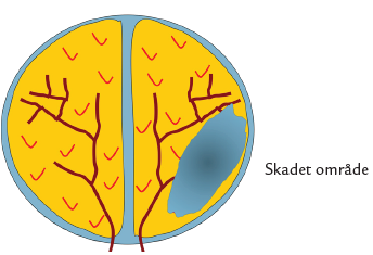 Tegning af hjernen med skadet område