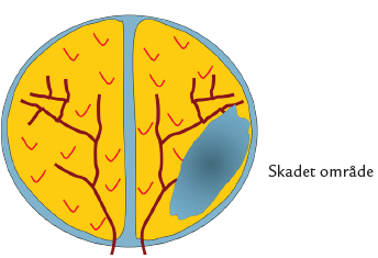 Tegning af hjernen med skadet omr&aring;de