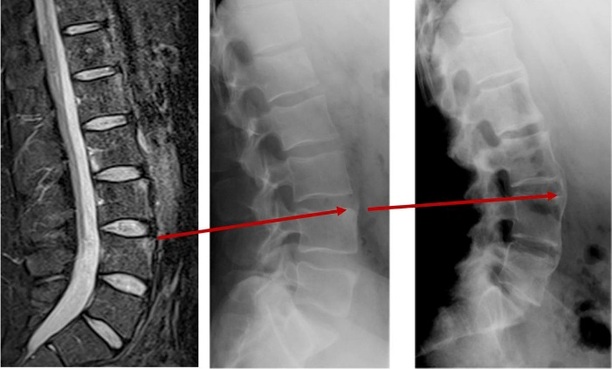 Skanninger af rygsøjlen der viser sammenvoksning af ryghvirvler